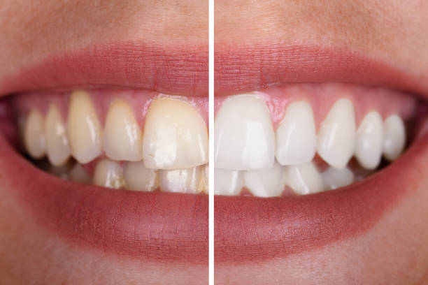 Close-up Of A Smiling Woman's Teeth Before And After Whitening
